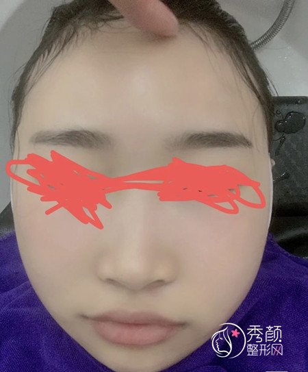 四川友谊罗恩做颧骨内推怎么样，我们一起来看看案例。