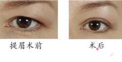 <b>上海第九人民医院提眉手术多少钱</b>