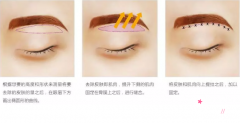 北京做提眉手术的价格是多少？手术费用贵不贵？