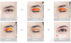 北京刘风卓修复双眼皮失败率高吗？