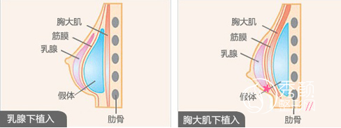 深圳颜美假体隆胸怎么样，大概需要多少钱？