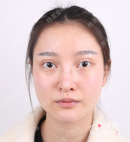 上海华美杨亚益有做双眼皮失败的案例吗？