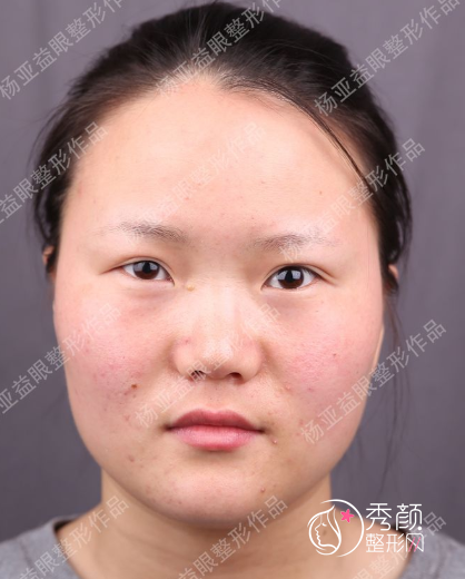 上海华美杨亚益有做双眼皮失败的案例吗？