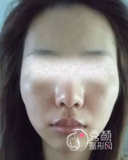 北京八大处磨骨跟下巴矫正2个月，变化是真的挺大的。