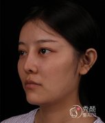 远赴西安找师俊莉做的鼻修复大家看看做的怎么样？