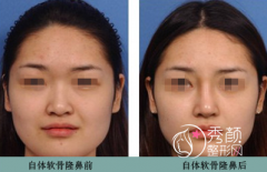 西安西京医院整形科哪个医生鼻子做的好？