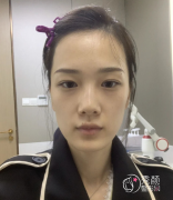 成都自体脂肪填充哪家医院好，不如先来看看我的全脸填充果吧。