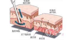 <b>上海安缦刘思达抽脂怎么样,有没有失败案例？</b>