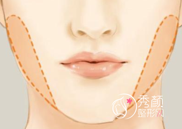 上海时光何晋龙做下颌角手术多久恢复？