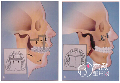 广州做正颌手术医院医生盘点：口腔医院、广大医院在榜！