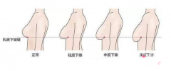 <b>胸部下垂矫正手术需要多少钱</b>