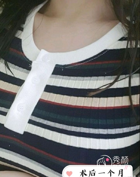 西安西京医院整形易成刚隆胸技术怎么样？