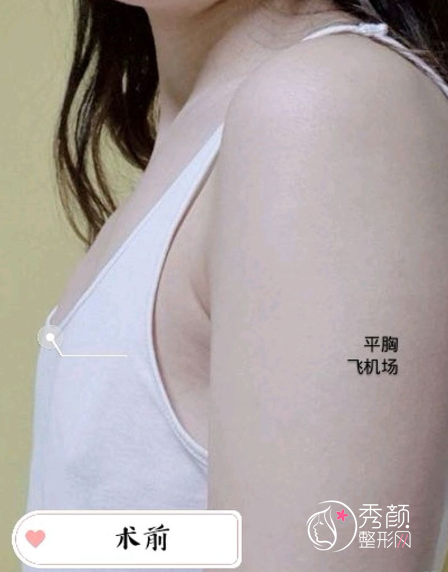 西安西京医院整形易成刚隆胸技术怎么样？