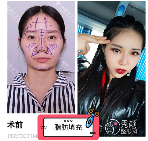 北京玉之光张红芳脂肪填充怎么样？