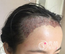 成都植发7个月终于满意了！看看我优越的发际线！