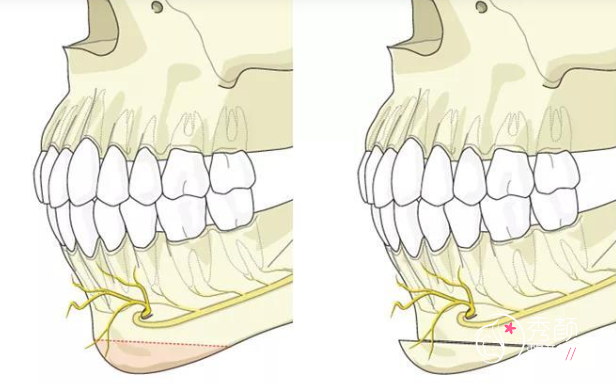 正颌手术果怎么样，正颌手术有什么风险和并发症？