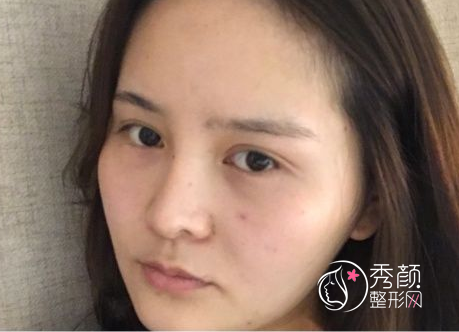 西安哪个医院做脂肪填充全脸好？脂肪填充案例分享。