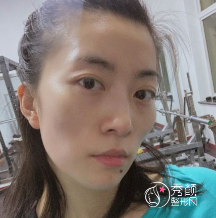 北京哪个医院做脂肪填充全脸好？脂肪填充案例分享。