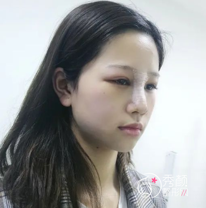 青岛诺德整形价格明细表一览+附隆鼻案例分享。