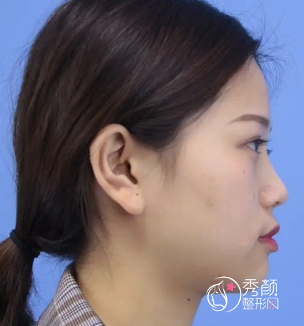 青岛诺德整形价格明细表一览+附隆鼻案例分享。