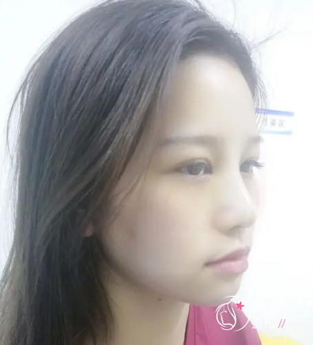 青岛诺德整形价格明细表一览+附隆鼻案例分享。