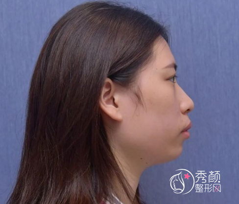 南京医科大吴国平正颌手术怎么样|个人资料|口碑|附正颌案例反馈。