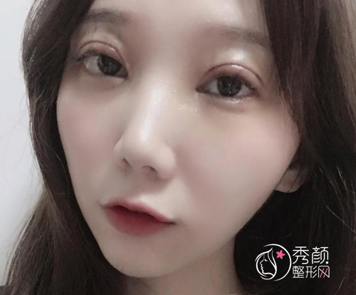 沈阳杏林史灵芝双眼皮技术怎么样|附割双眼皮案例反馈