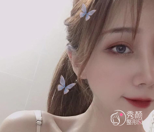 沈阳杏林史灵芝双眼皮技术怎么样|附割双眼皮案例反馈