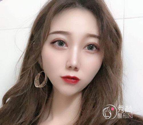 沈阳杏林史灵芝双眼皮技术怎么样|附割双眼皮案例反馈