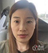 晒一晒我的上海第九人民医院自体脂肪全脸填充成果~