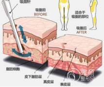 <b>自体脂肪填充面部有风险吗?脸部脂肪填充的危害和后遗症.</b>