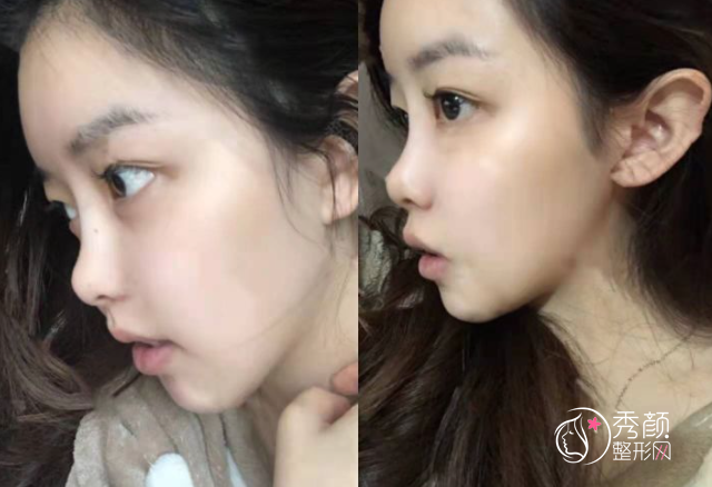 青岛伊美尔还是华韩好？附整形专家团队+隆鼻案例反馈分享