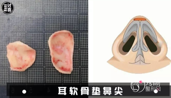 西安国际医学中心师俊莉隆鼻怎么样|案例|审美|口碑