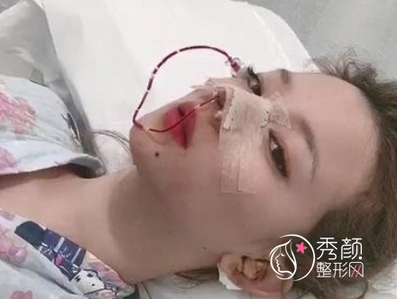 北京八大处尤建军隆鼻怎么样|附隆鼻案例术后反馈分享。