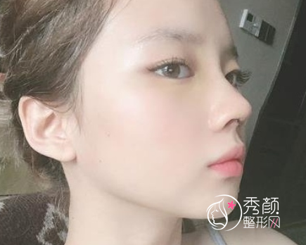 北京八大处尤建军隆鼻怎么样|附隆鼻案例术后反馈分享。