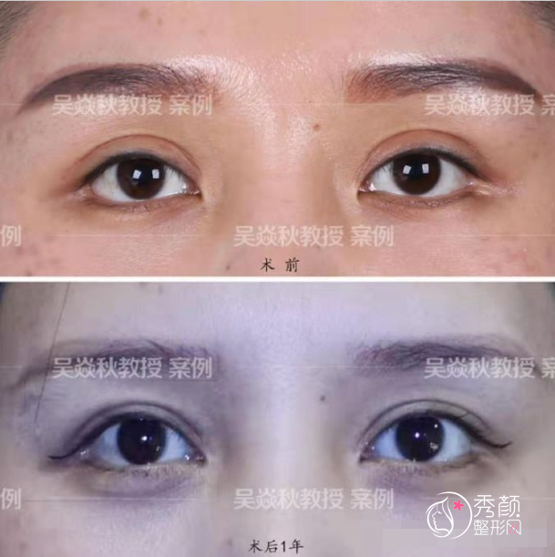 北京联合丽格吴焱秋双眼皮修复案例（宽修窄）
