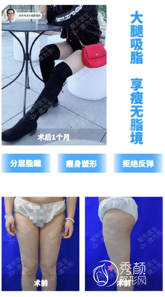 上海百达丽唐为东吸脂怎么样|附大腿吸脂案例