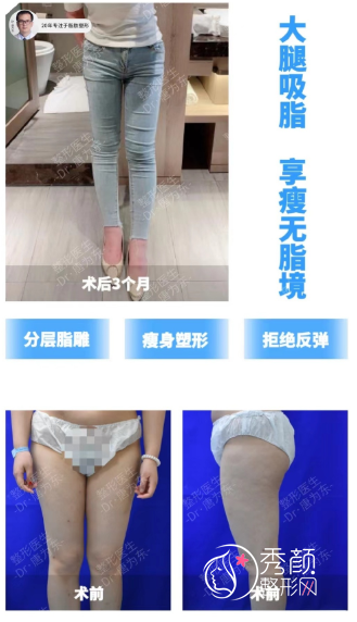 上海百达丽唐为东吸脂怎么样|附大腿吸脂案例