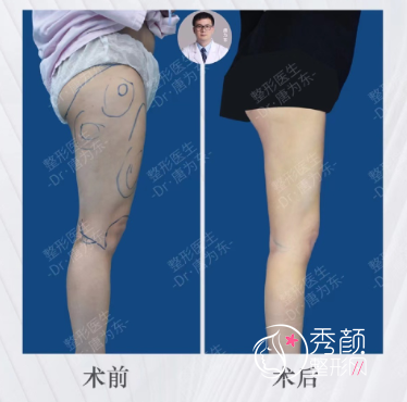 上海百达丽唐为东吸脂怎么样|附大腿吸脂案例
