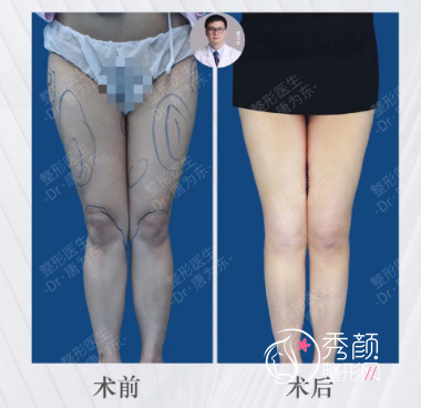 上海百达丽唐为东吸脂怎么样|附大腿吸脂案例