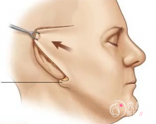 宁波拉皮手术哪家医院好|宁波面部提升价格表