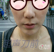 【超声提拉案例】前几天去上海做了美版超声提拉，终于体验超声提拉了～