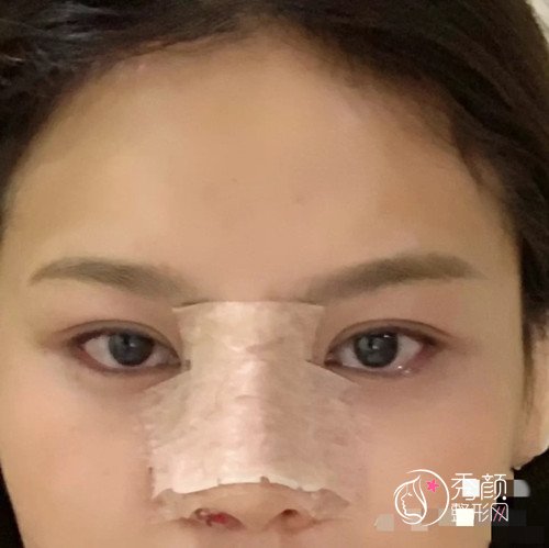 大连明医汇王艇隆鼻怎么样|附隆鼻案例反馈
