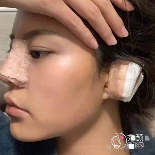 大连明医汇王艇隆鼻怎么样|附隆鼻案例反馈