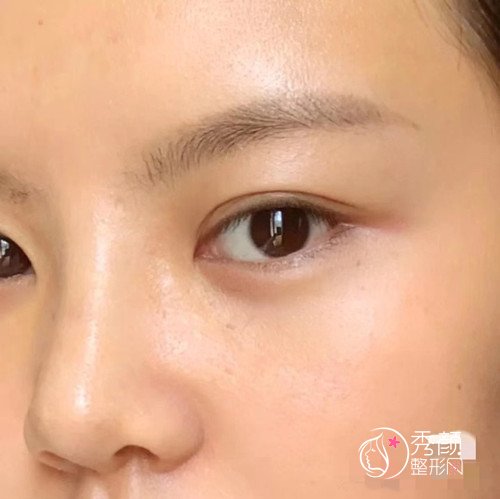 大连明医汇王艇隆鼻怎么样|附隆鼻案例反馈