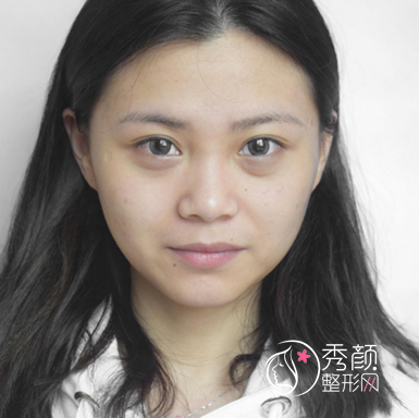 大连天俪杜轶男隆鼻怎么样|附隆鼻案例术后反馈