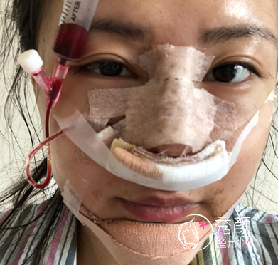 大连天俪杜轶男隆鼻怎么样|附隆鼻案例术后反馈