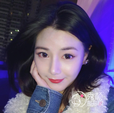 大连天俪杜轶男隆鼻怎么样|附隆鼻案例术后反馈