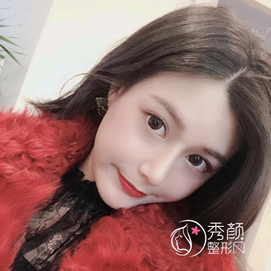 大连天俪杜轶男隆鼻怎么样|附隆鼻案例术后反馈