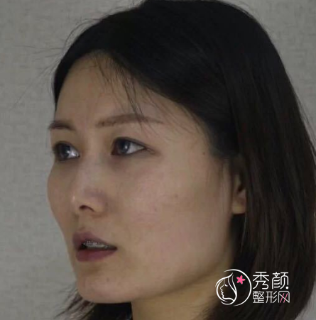 上海首尔丽格崔荣达磨骨口碑怎么样|附颧骨内推案例